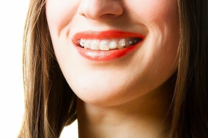 clear braces