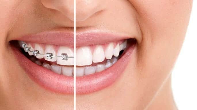 mini diamond braces