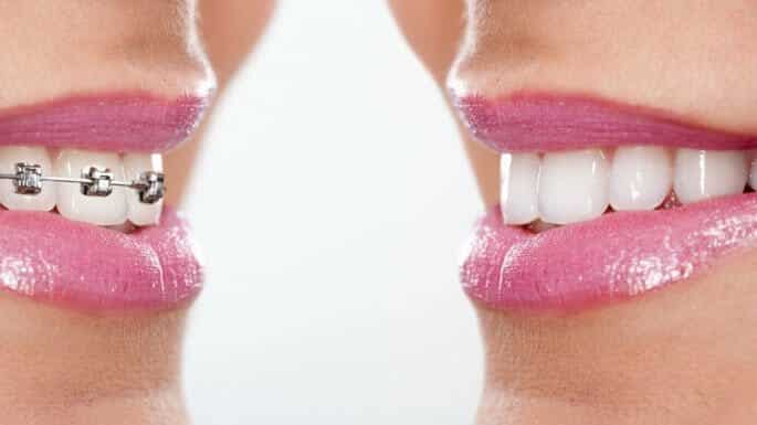 Invisalign vs Braces
