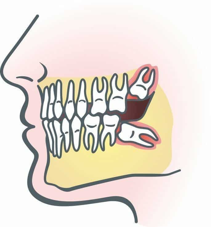wisdom teeth