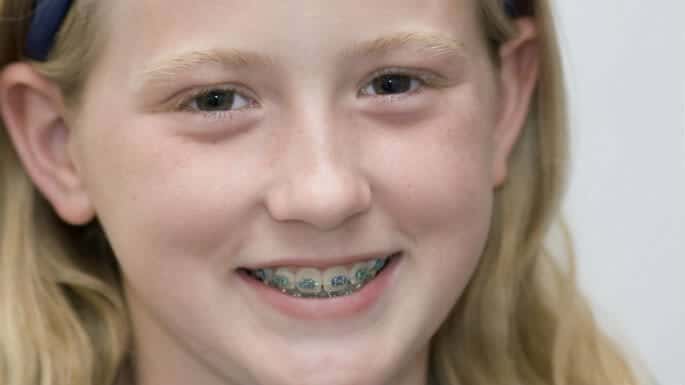 braces