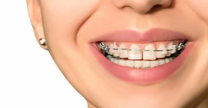 Types of braces
