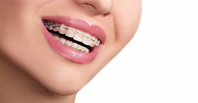 Ceramic Braces