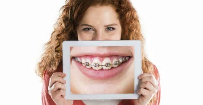 Problems with Braces