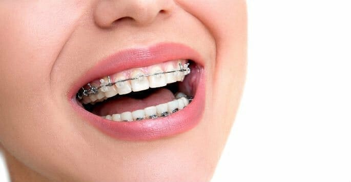 Diamond braces vs normal braces