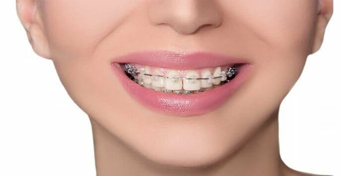 Ceramic braces