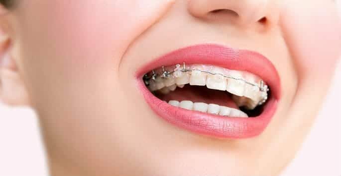 ceramic braces