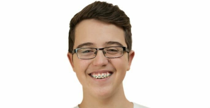 braces for teens