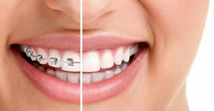 braces