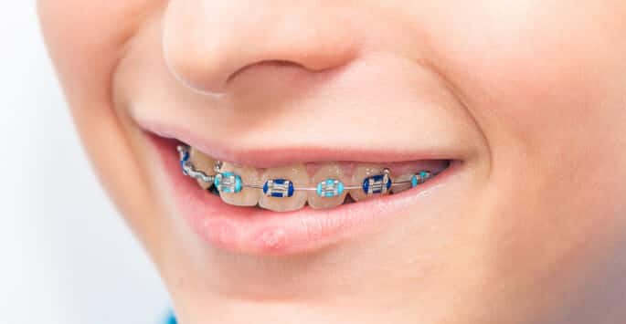 Braces