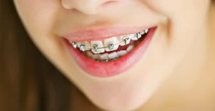 braces for kids