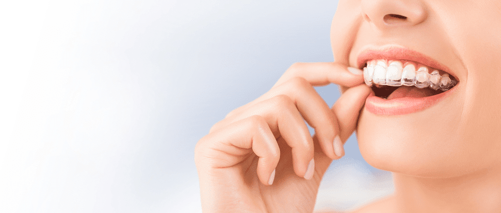 Clear Aligners